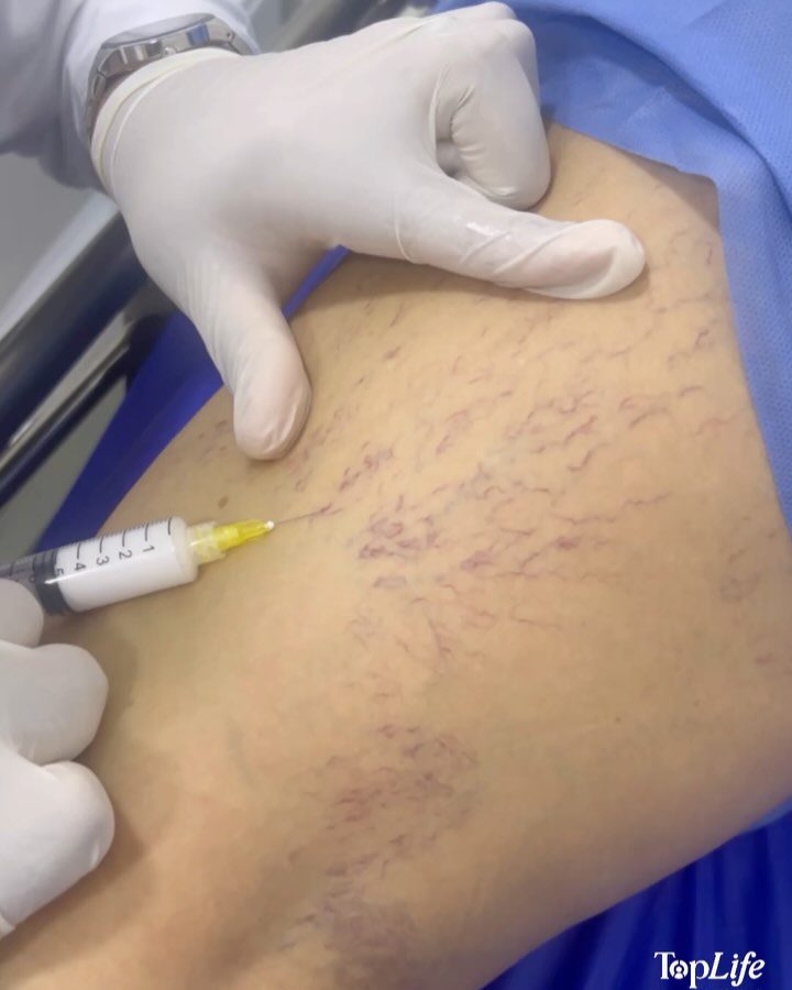 Tratamientos Vasculares en Cartagena: Várices y Úlceras